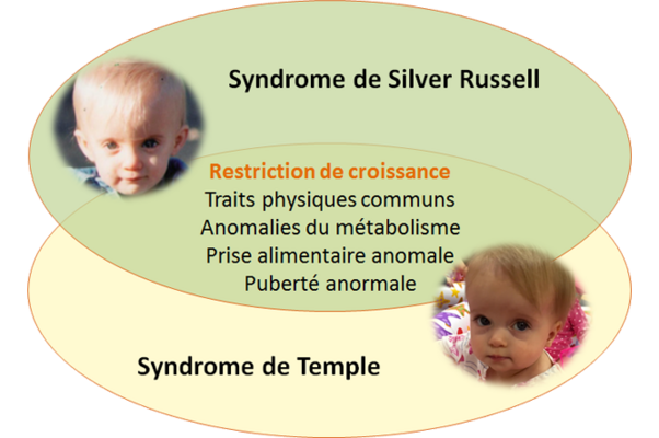 Visuel pour l'actualité Syndrome de Silver-Russell et syndrome de Temple : nouvelles avancées dans l’élucidation des mécanismes épigénétiques impliqués dans la croissance fœtale