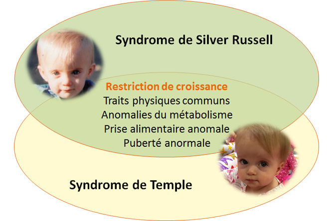 Visuel pour l'actualité Syndrome de Silver-Russell et syndrome de Temple : nouvelles avancées dans l’élucidation des mécanismes épigénétiques impliqués dans la croissance fœtale