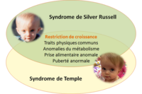 Visuel pour l'actualit&eacute; Syndrome de Silver-Russell et syndrome de Temple : nouvelles avanc&eacute;es dans l&rsquo;&eacute;lucidation des m&eacute;canismes &eacute;pig&eacute;n&eacute;tiques impliqu&eacute;s dans la croissance f&oelig;tale